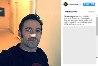 ヒュー・ジャックマン、鼻の皮膚がんをまた除去手術！ 画像